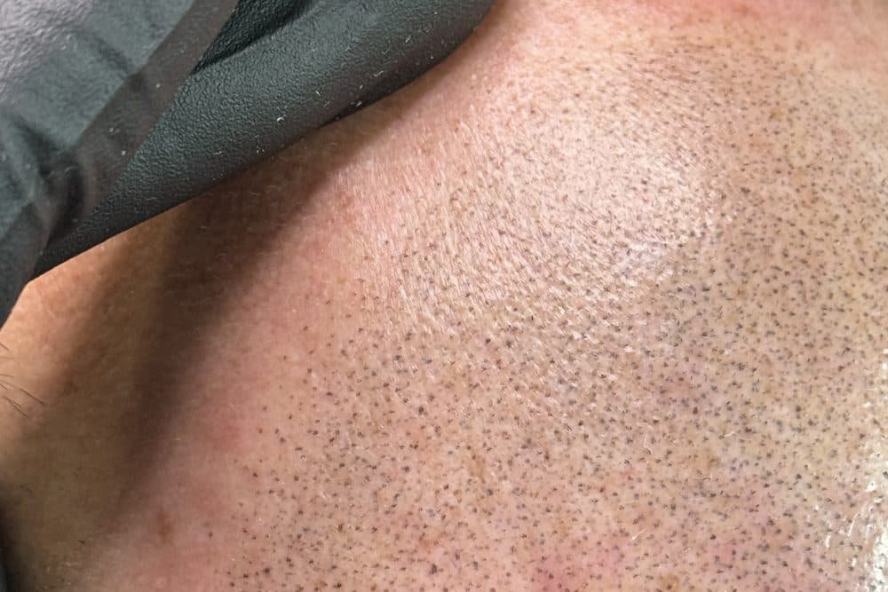 Close up of scalp micropigmentation, showing the individual impressions of pigment